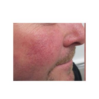 ROSACEAS, KIPIROSODÁSRA HAJLAMOS, ÉRZÉKENY BŐR ÁPOLÁSA